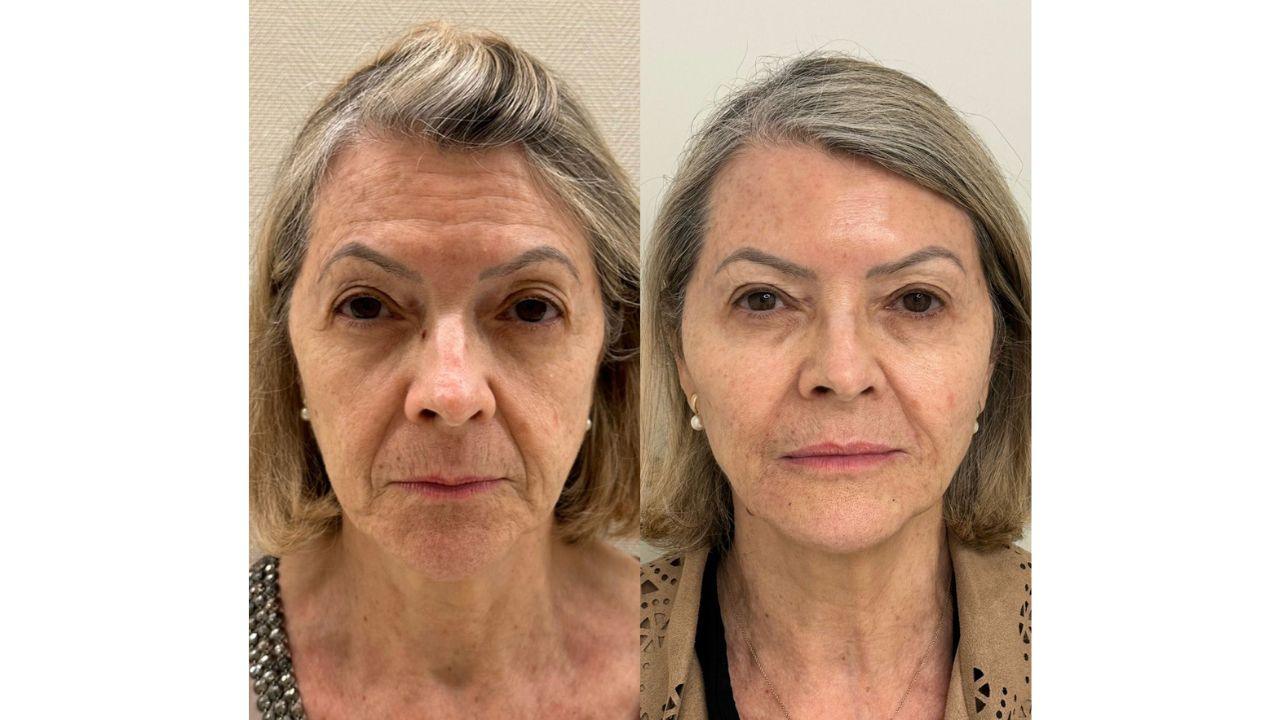 preenchimento antes e depois