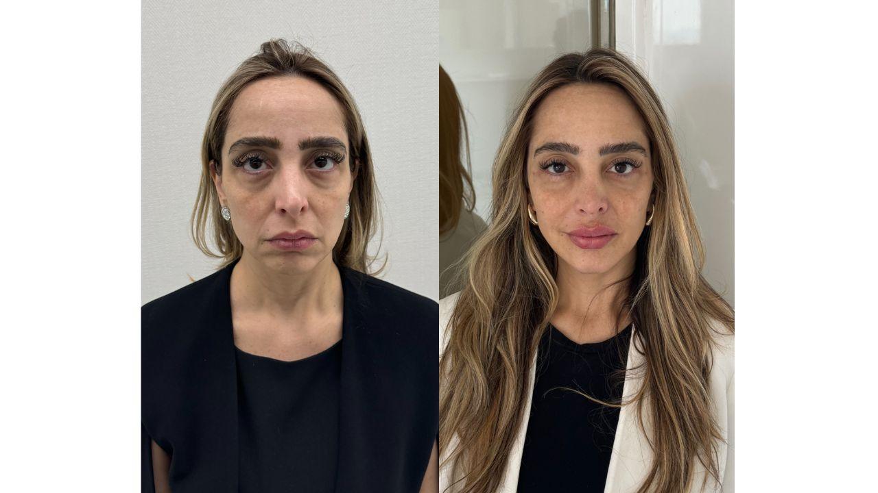 preenchimento antes e depois